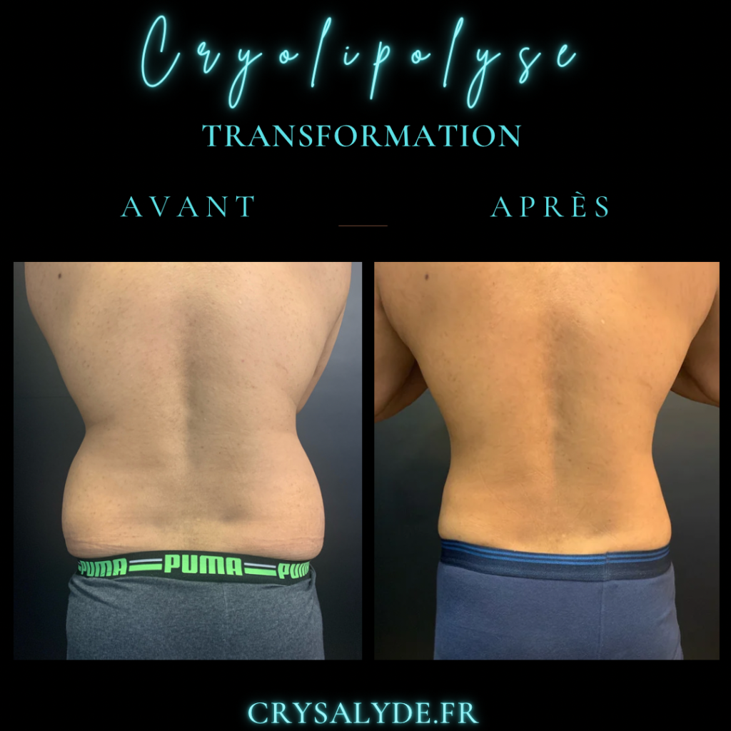 graisse sous cutanee abdominale et cryolipolyse