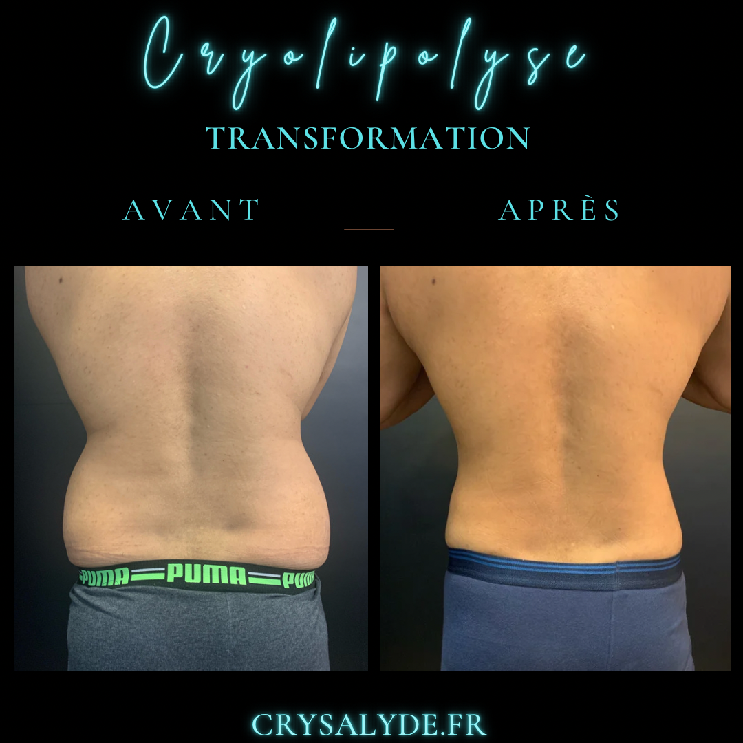 Avant/Après cryolipolyse