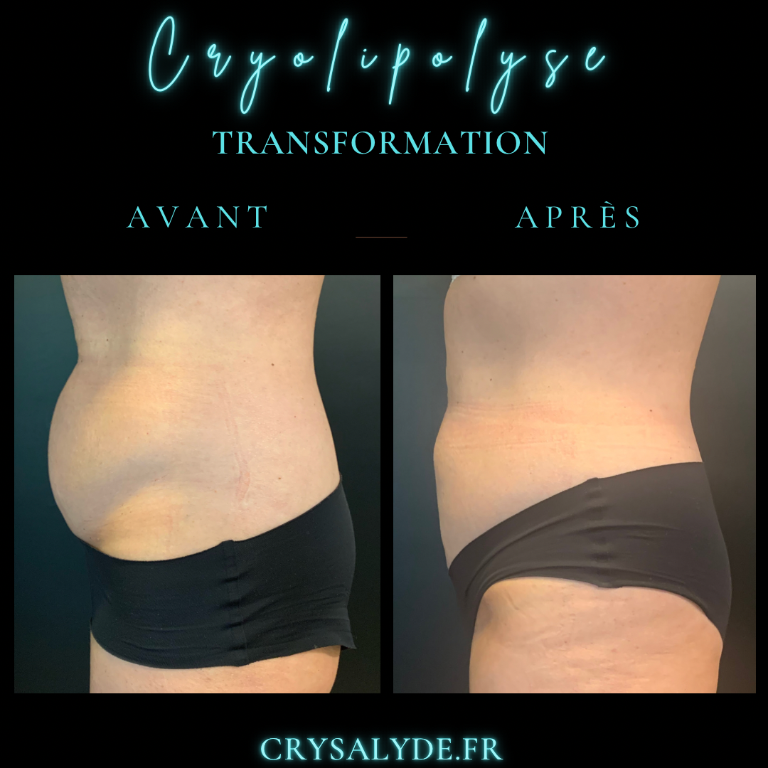 Avant et Après cryolipolyse