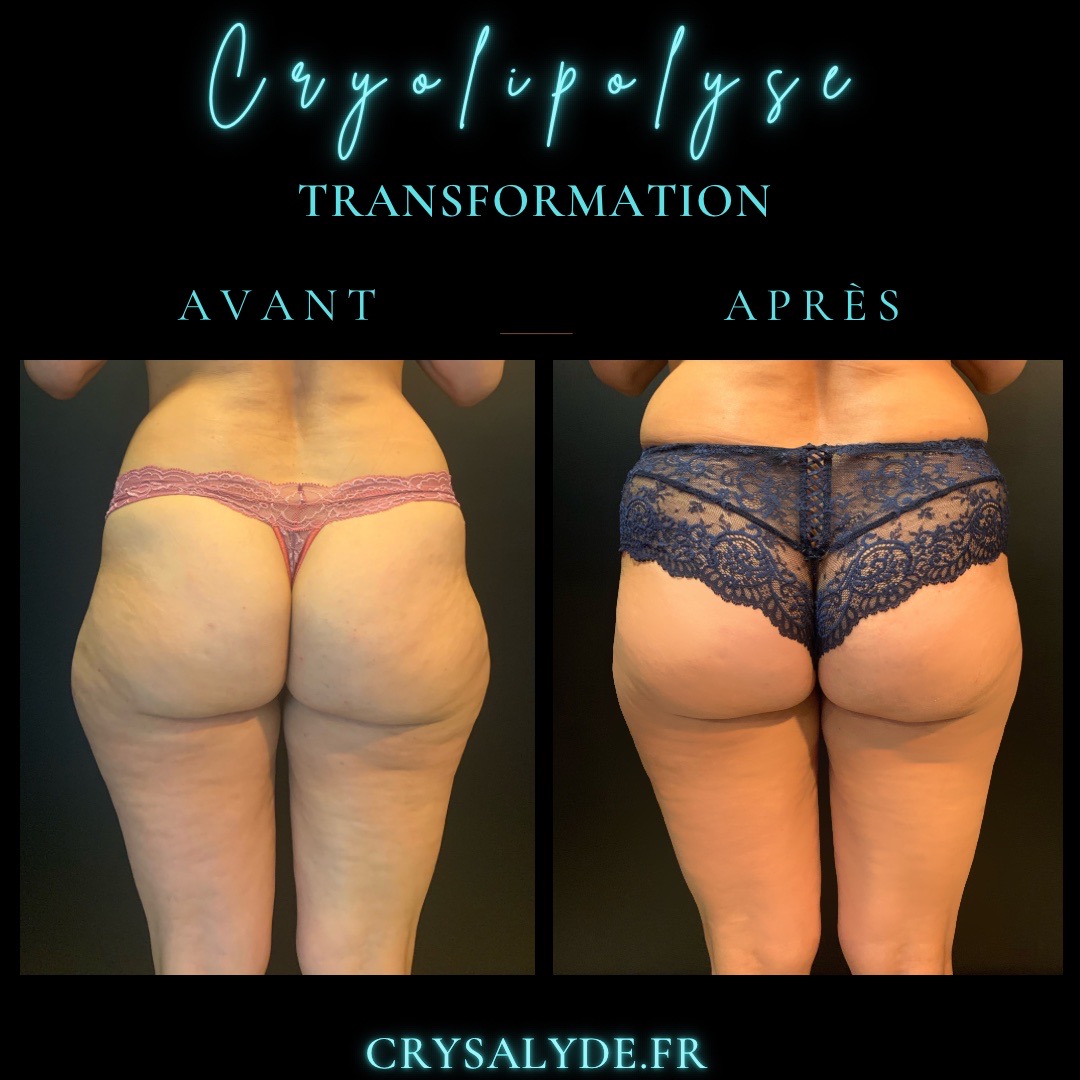 cryolipolyse Avant et Après 