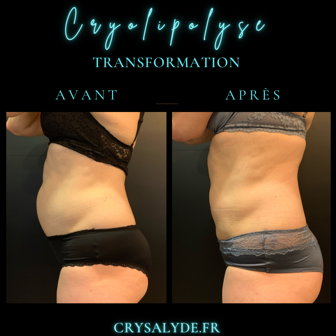 transformation avec cryolipolyse