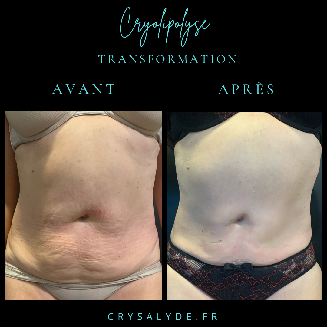 transformation Avant/Après cryolipolyse