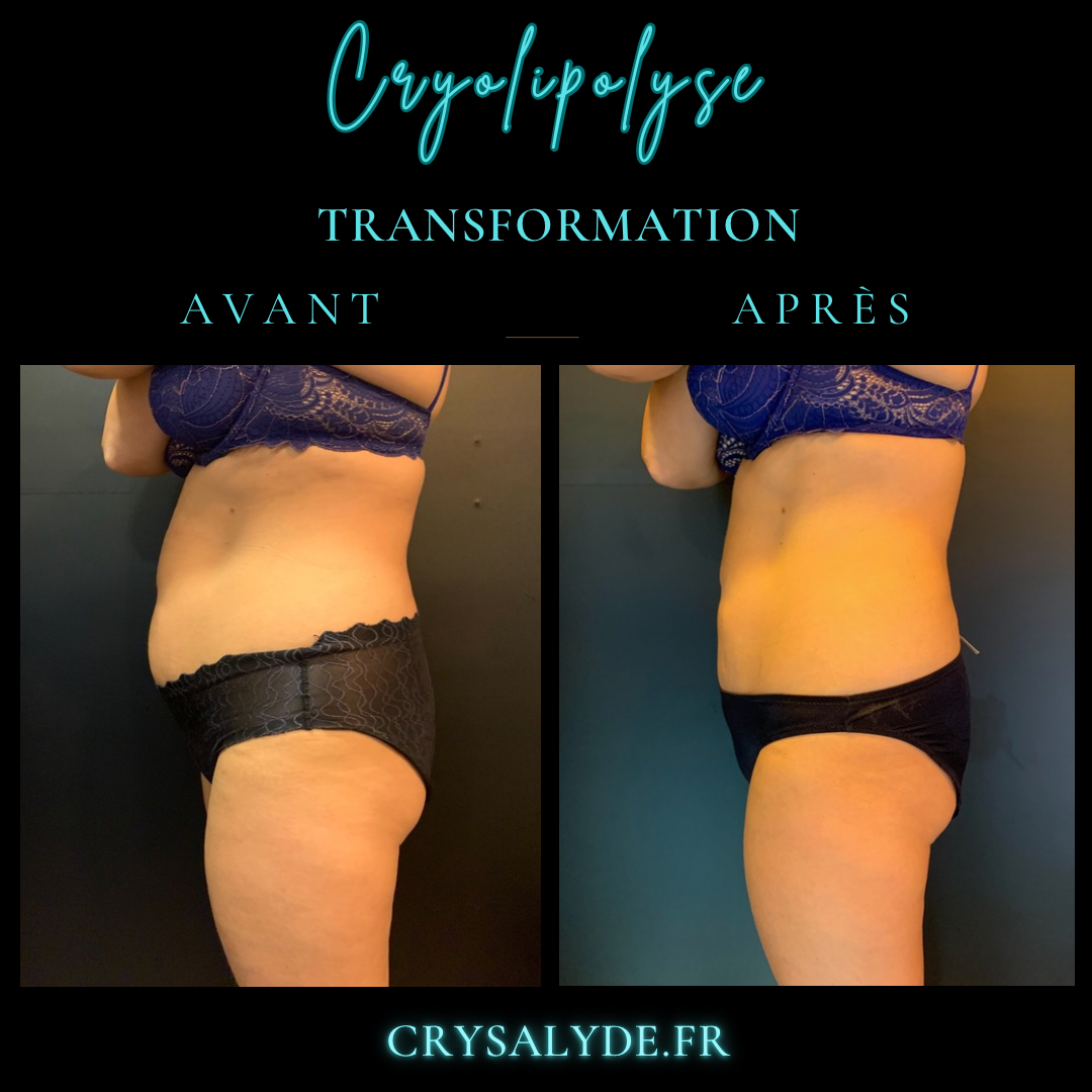 resultats apres cryolipolyse