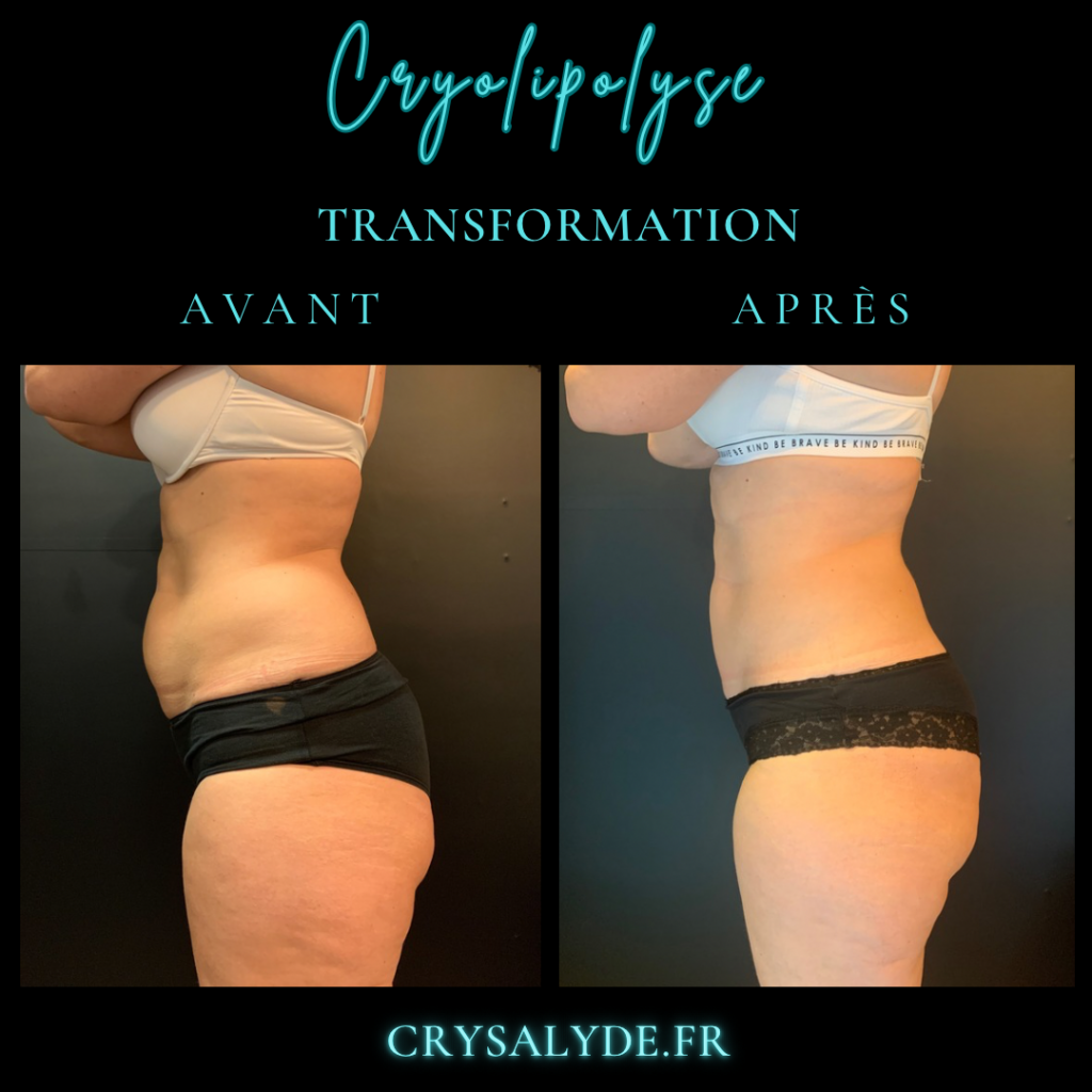 Perte de Graisse Post-Grossesse 